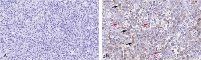 Expression and Prognostic Significance of PD-L2 in Diffuse Large B-Cell Lymphoma